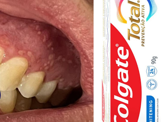 Anvisa proíbe comercialização de creme dental da Colgate por denúncias de reação após o uso